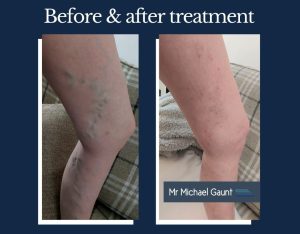 Flying with varicose veins: before and after varicose vein treatment by Mr Michael Gaunt. 