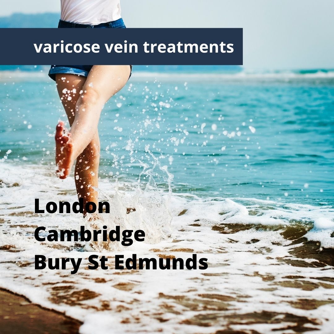 Healthy legs: varicose vein treatment